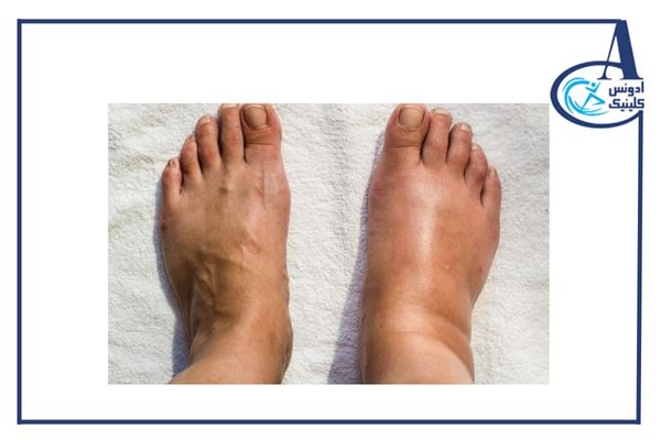 آشنایی با پای شارکو-ادونس کلینیک