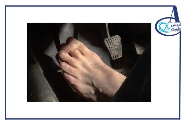 چالشهای رانندگی با پروتز پا